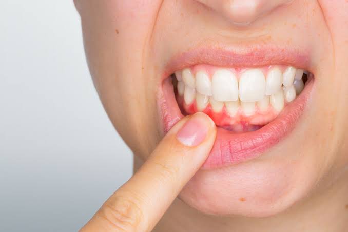 Periodontal (Gum) Treatment