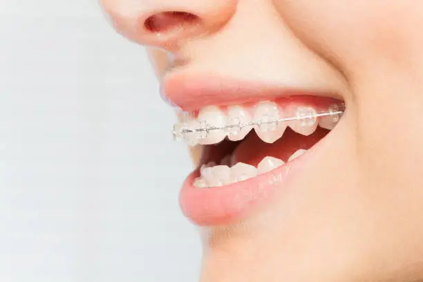 Braces & Orthodontic Treatment