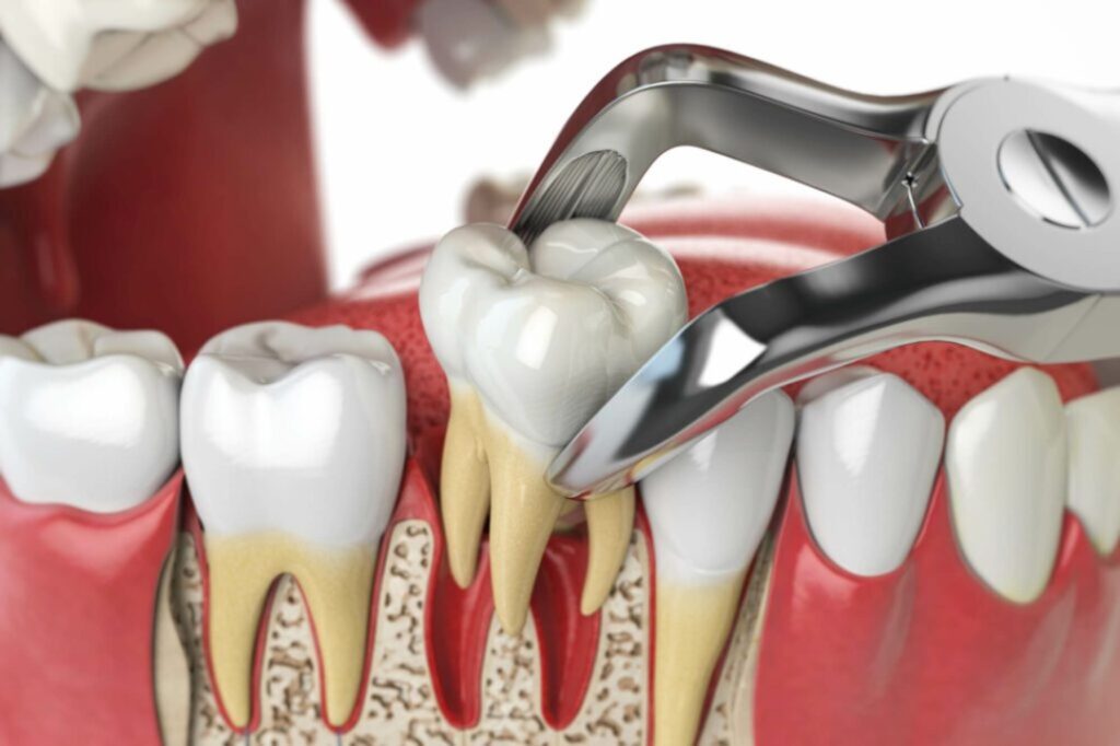 Tooth Extractions & Oral Surgery